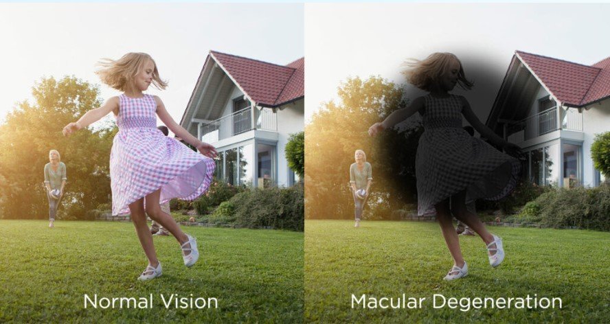 Macular degeneration vision report