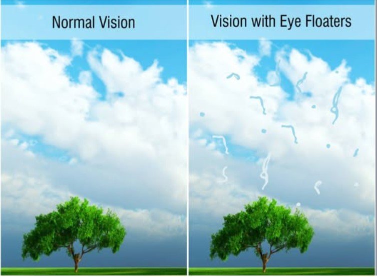 Normal vision versus vision with floaters